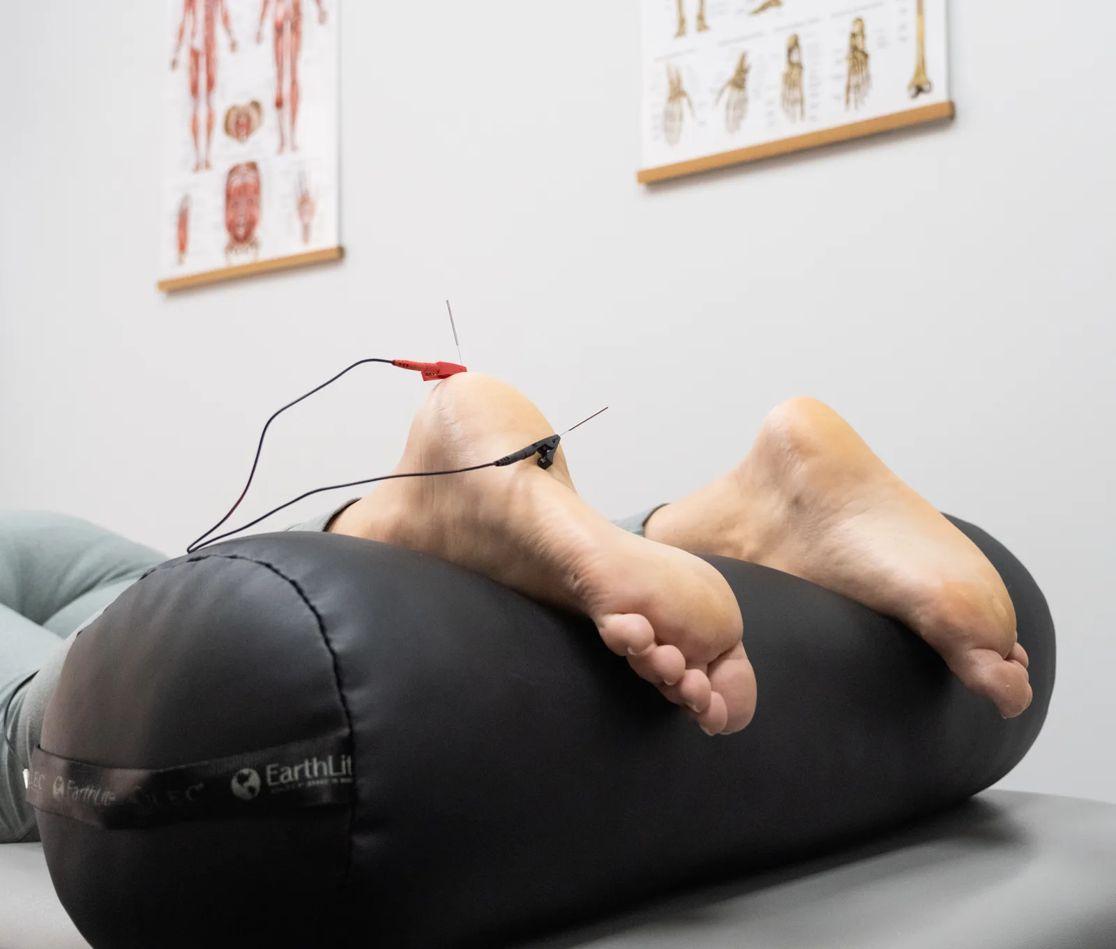 Dry Needling